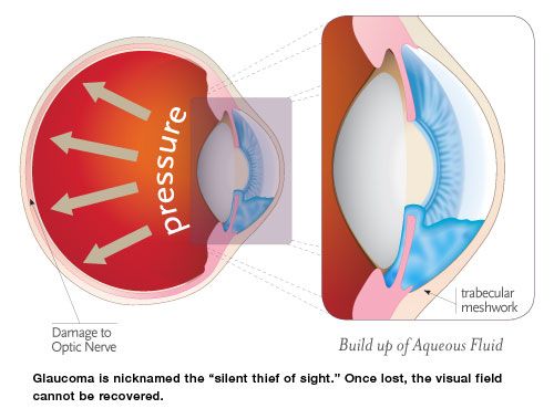 Intraocular pressure (IOP) Intraocular pressure (IOP)